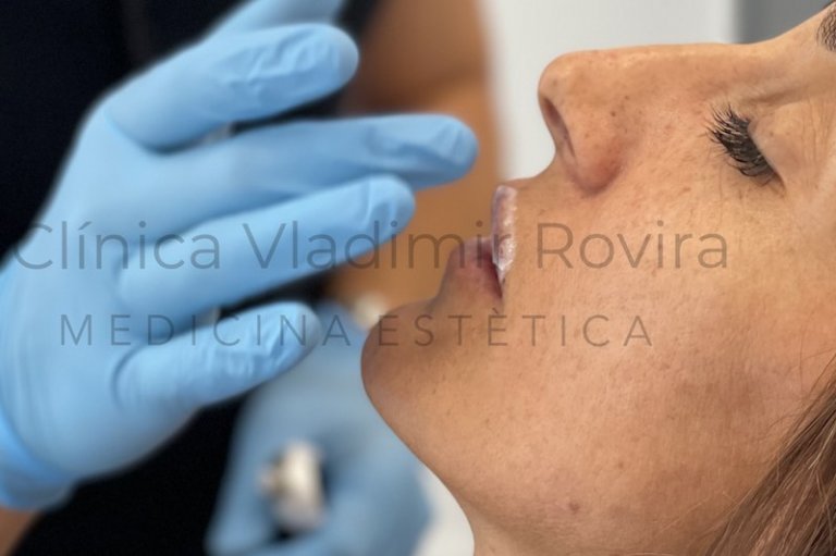 Aplicacion crema topica anestesica - dr. vladimir rovira
