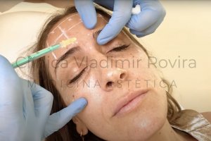 Eliminar las Arrugas del entrecejo - Dr. Vladimir Rovira en Barcelona