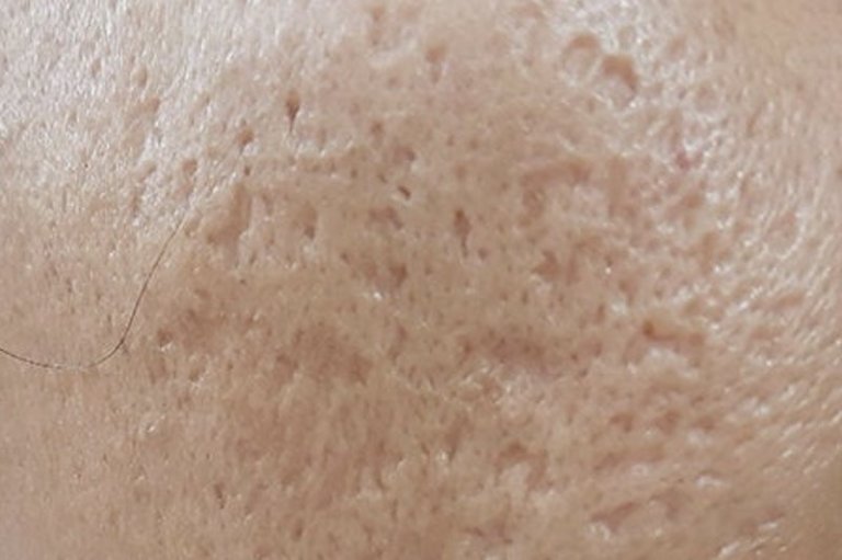 Marcas de Acne - Tipos de cicatrices y Marcas de Acne