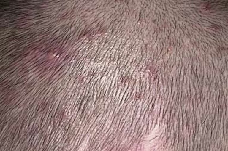 acne cuero cabelludo - Tpos de cicatrices y marcas de acne