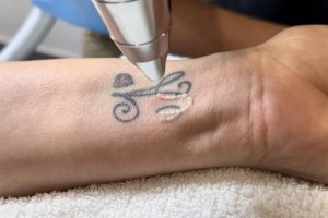 eliminar tatuajes