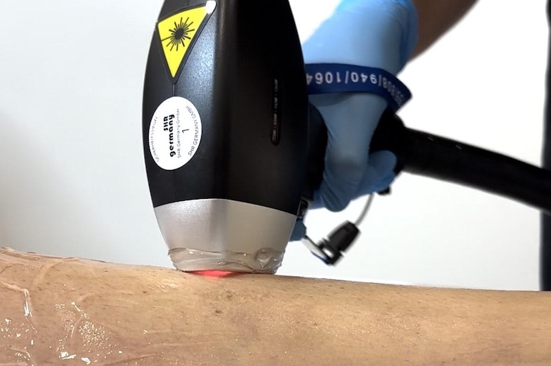 Depilación Láser en Barcelona en la Clínica Vladimir Rovira