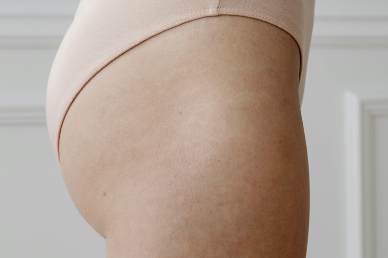 Rellenos corporales para tratar volumen