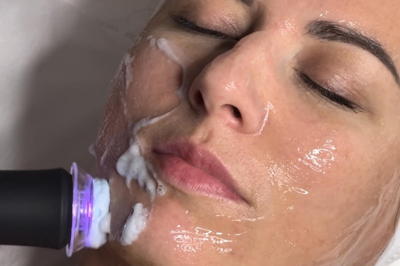 Los mejores tratamientos para rejuvenecer la piel