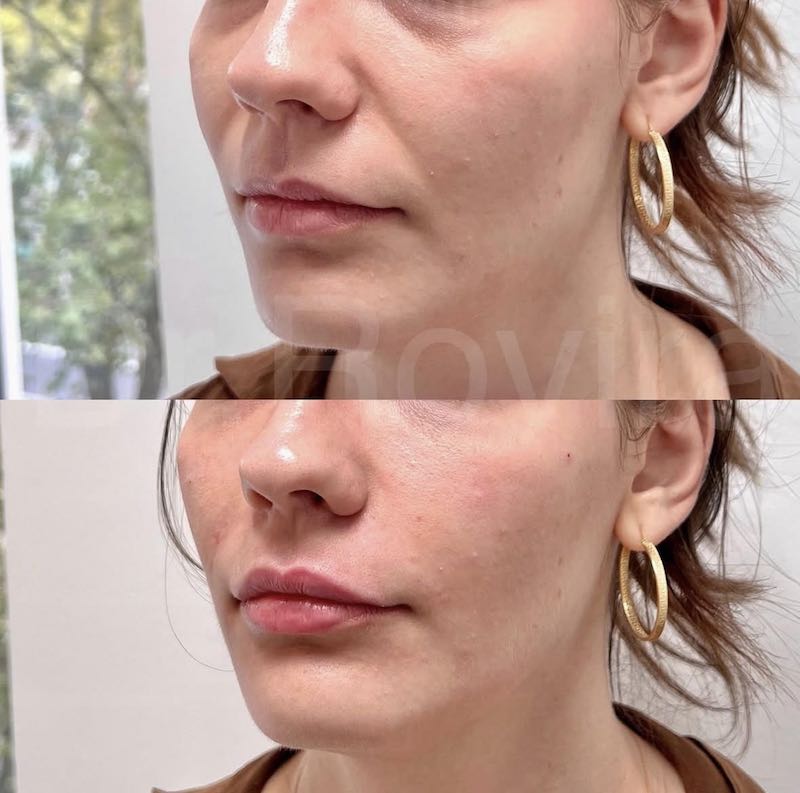 antes y después ácido Hialurónico