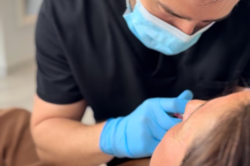 Rellenos con Juvederm en Barcelona