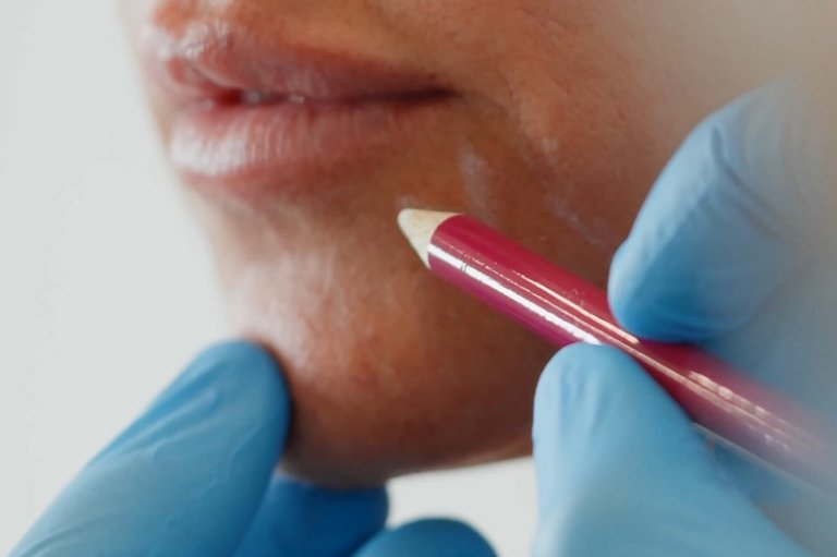 juvederm rellenos