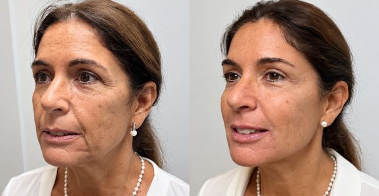 antes y depues